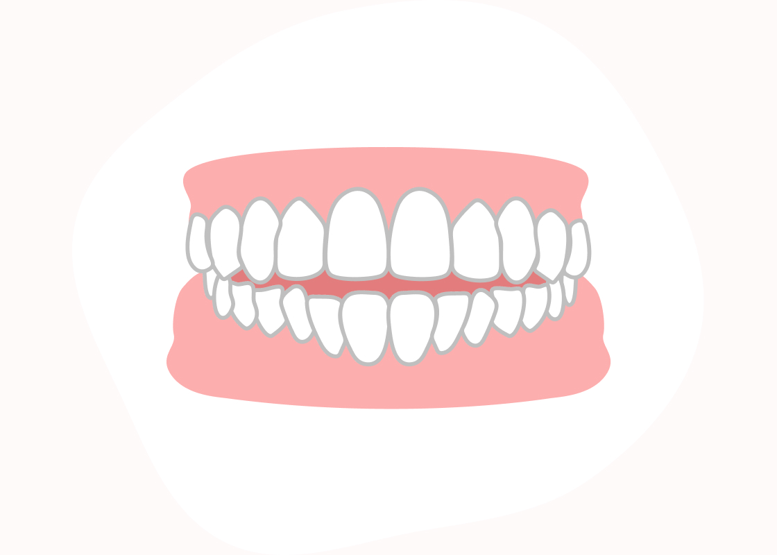 開咬（かいこう）